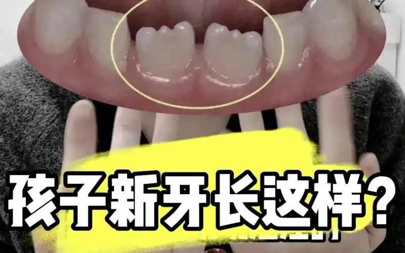 宝宝新长的门牙坑坑洼洼,是正常现象么?