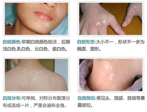 首页 病种百科 症状   随着病情的不同,白斑颜色也显示不同的情况.