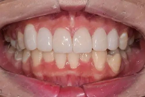 瓷贴面的价格_相关案例_新氧整形