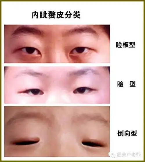 内眦赘皮矫正术