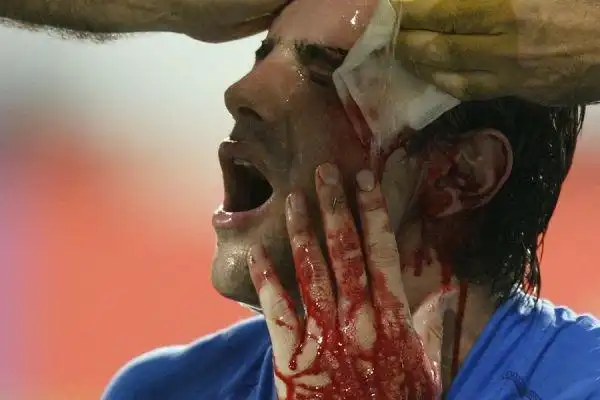 血腥!米兰铁卫面部遭钢钉踩踏 23岁帅哥或"毁容"