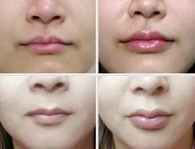 丰唇的注意事项有哪些