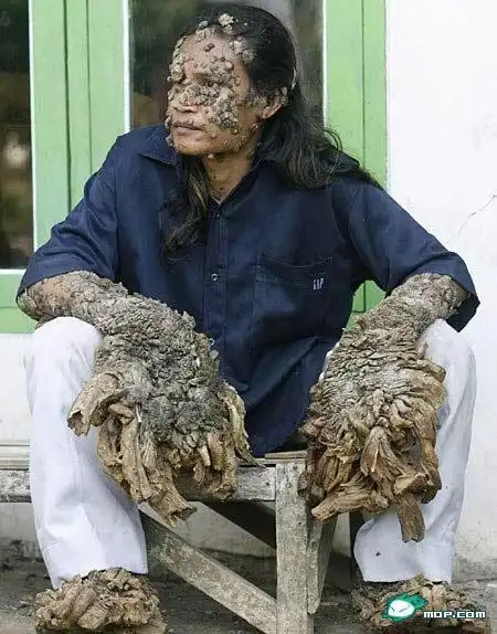 全球最丑陋的人,第一名