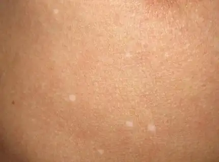 特发性点状白斑:表现为针头至豆大的乳白色白斑,常随年龄增多,但不