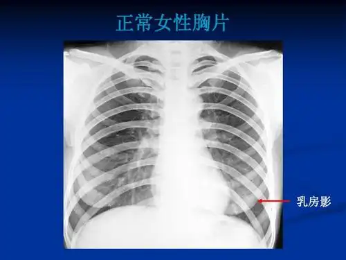 正常女性胸片 乳房影
