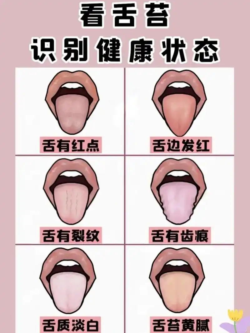 6种舌苔照片帮你识别健康情况,你中了哪个
