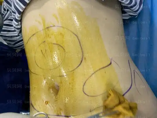 上海华美医疗美容医院何斌腰腹部吸脂案例