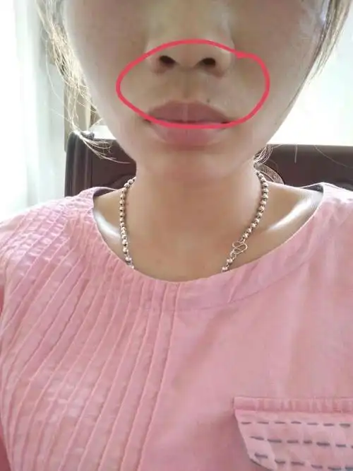 我想问一下嘴边上的那个黑色的怎么去掉?