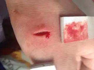 手上有口子血流的少严重吗