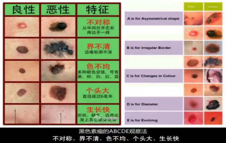 知名歌手因黑色素瘤去世医生提醒预防这种病一定要防晒
