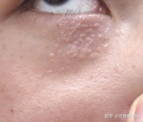 为什么眼睛会长汗管瘤