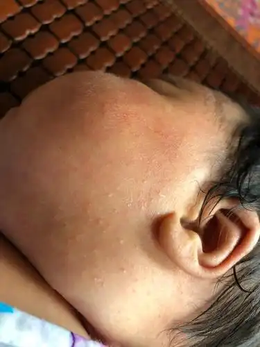 这个是湿疹还是热痱子