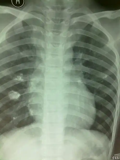 儿科专业讨论版 69 结核与反复呼吸道感染 再次复查胸片,发现肺部