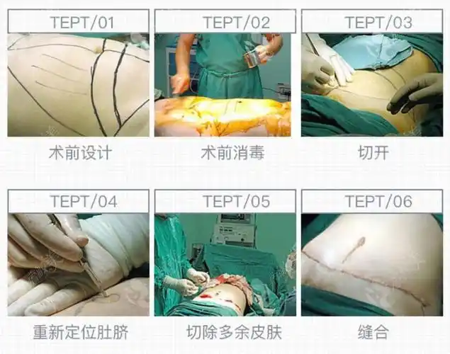 西安腹壁整形术医生推荐来看崔鑫医生技术好不好