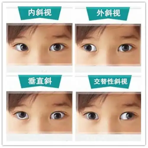 斜视不及时治疗会影响孩子一生,如何尽早发现孩子斜视?_手术