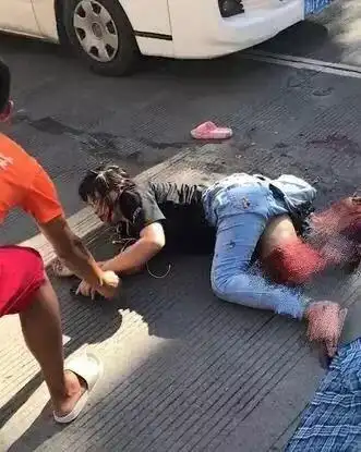 绍兴惨烈车祸!女子遭叉车撞倒,小腿皮肉被剥落,司机弃车逃逸!