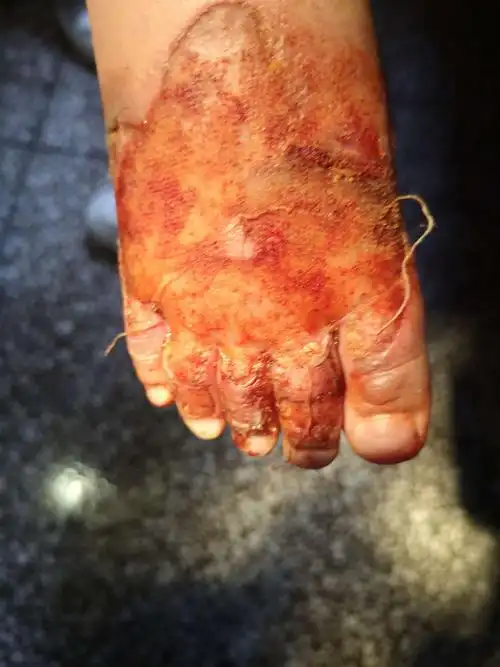 三度烧伤大面积烧伤,还是看中医院急诊科