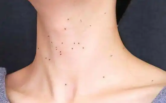 真实女性hpv感染初期图女性hpv图片样子及症状