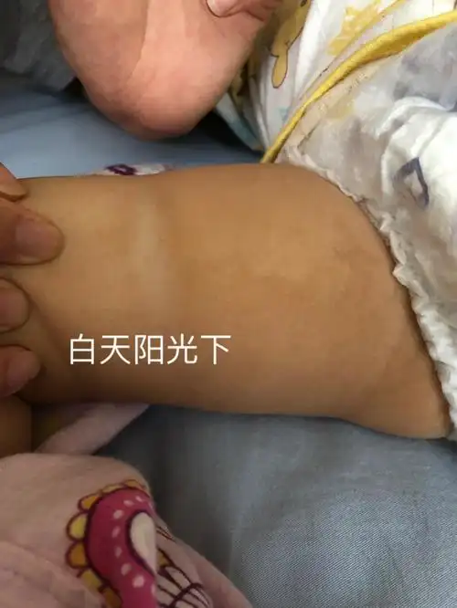 宝宝褶皱泛白肤色不均匀咖啡斑未完