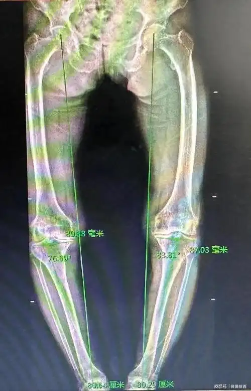 "o型腿变形记"——双膝关节置换术治疗双膝关节内翻畸形