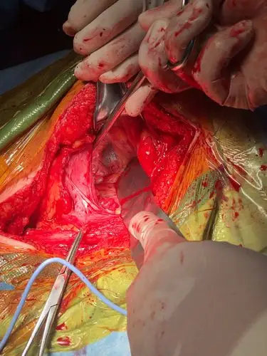 严重下腹部疤痕第四次手术一例