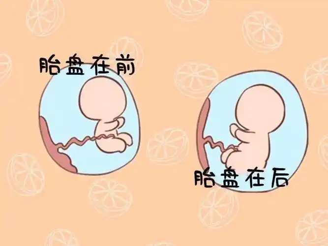 胎盘长在哪里好?剖腹产后腰痛是打麻醉惹的祸?_腰部_位置_后壁