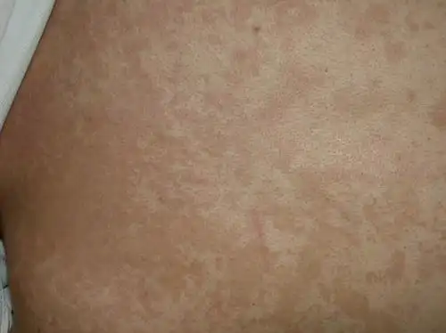 重庆花斑癣医院_重庆治疗花斑癣哪家医院好_重庆治疗花斑癣权威的医院