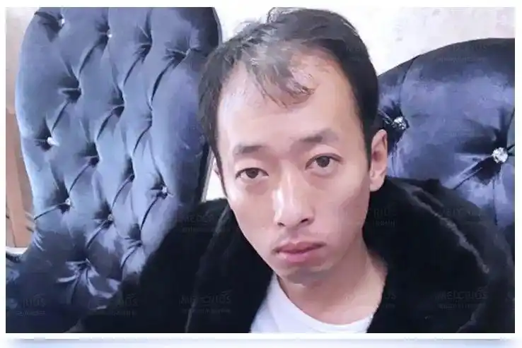 4小时解决10年脱发秃顶大叔秒变小鲜肉一次改变脱发秃顶发际线后移