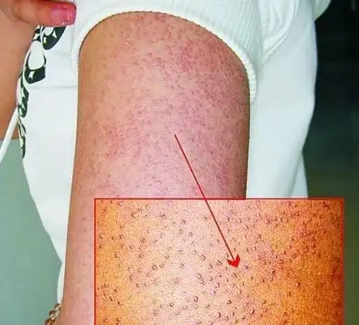 从粗糙到光滑肌肤鸡皮肤的自救指南来了