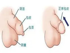 因先天性小儿包茎,后天性小儿包茎类型不一样,症状也不同,所以病因