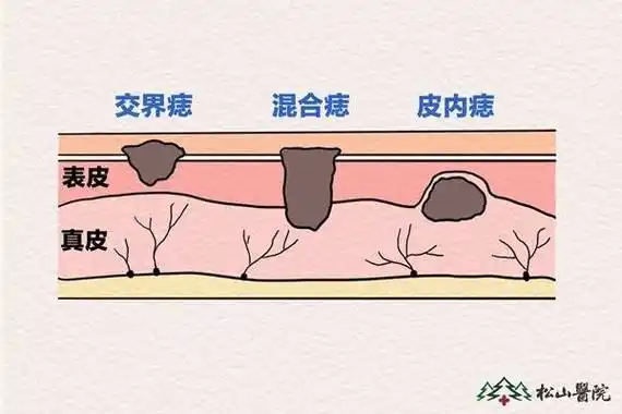 痣可能会癌变?松山医院:5点自测危险程度