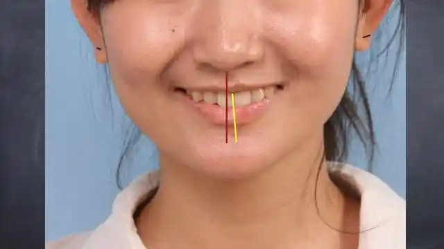 成人中线不正矫正案例 (原创)