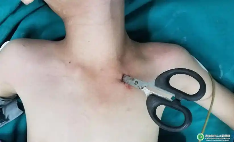 8龄童摔跤致剪刀刺入胸壁 胸外科专家精湛手术转危为安