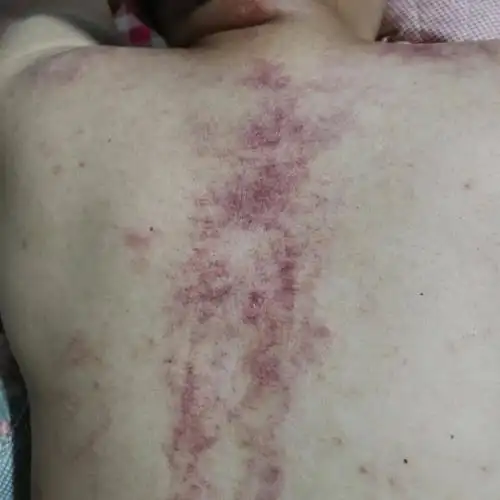 科普如何通过刮痧后皮肤呈现的颜色来判断身体状况