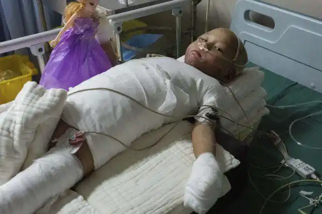 4 岁女童全身严重烧伤,崩溃痛哭:"哥哥为什么要拿火烧我"