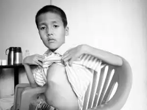 哥哥患上马凡氏综合症不幸夭折小姐弟又因同样的病缠身急需手术续命