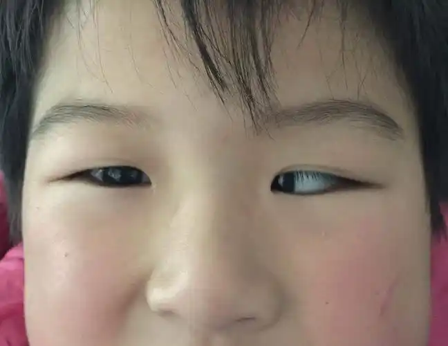 什么是斜视转载