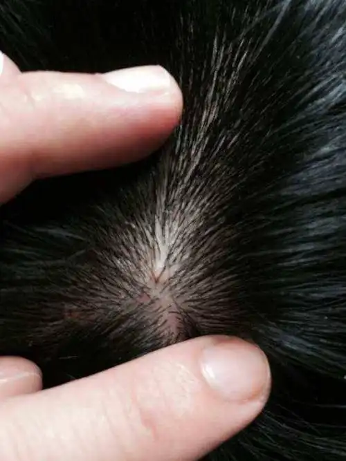 头皮多脂,油腻发亮,脱屑较多,常伴有不同程度着痒,头发里面的小疙瘩一