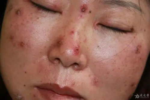 女性面部出现疱疹4天