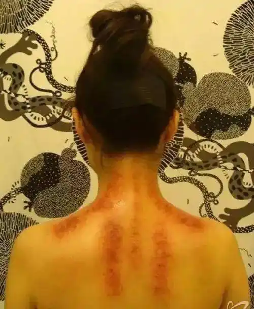 背部刮痧,可以看出一个人的身体健康状况!