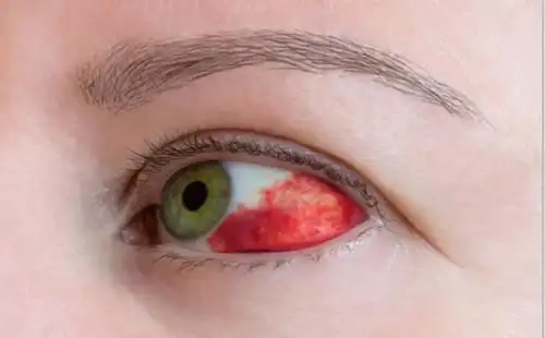 眼白上有红色血块医生竟然说没事