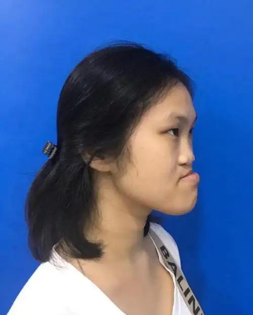 女孩因从小有兔唇被人嘲笑,经过10个小时整容手术后如今判若两人