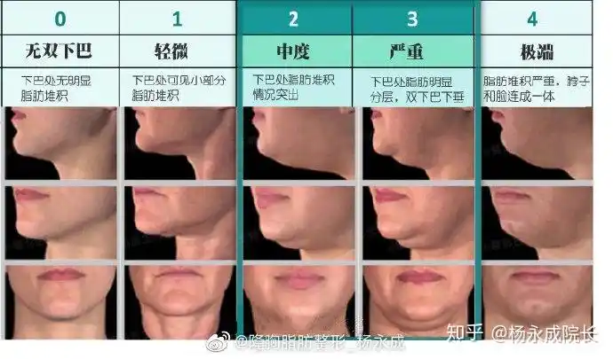 "下颌线"在哪里?