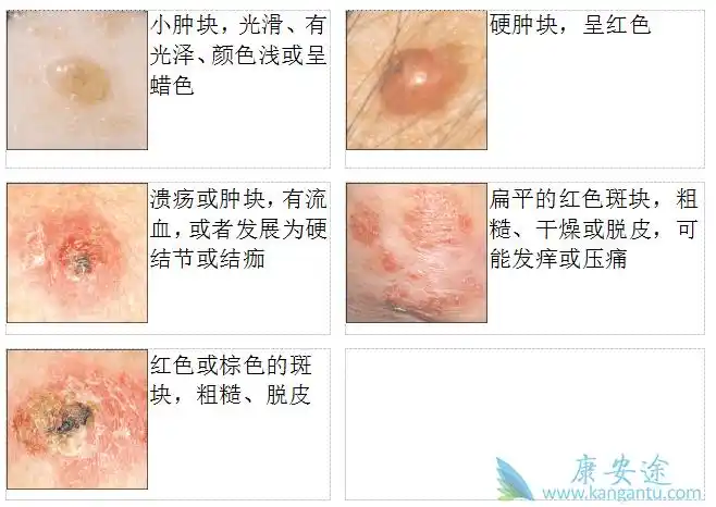 不同类型的皮肤癌症状不同