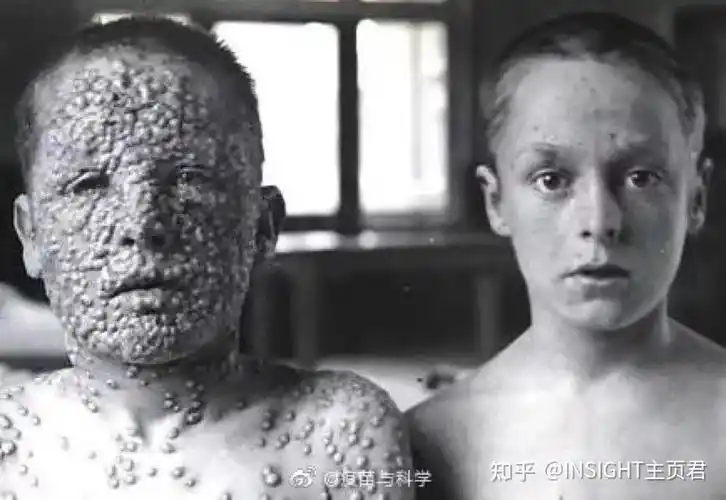 美国惊现"天花病毒冷冻瓶"?