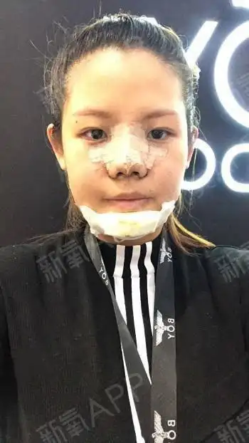 做完手术的第五天了,每天都有些煎熬,很多东西吃不了_圈子-新氧美容