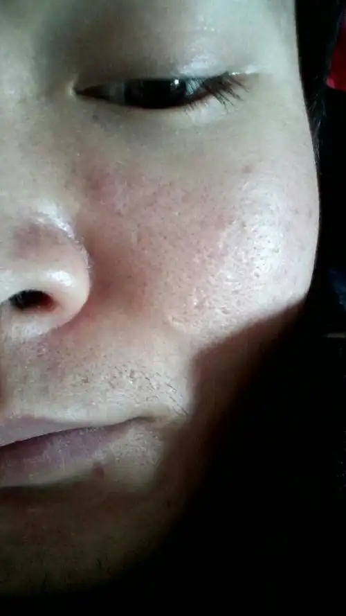 挤黑头多导致毛孔粗大这个样了,现不敢挤.怎么办?