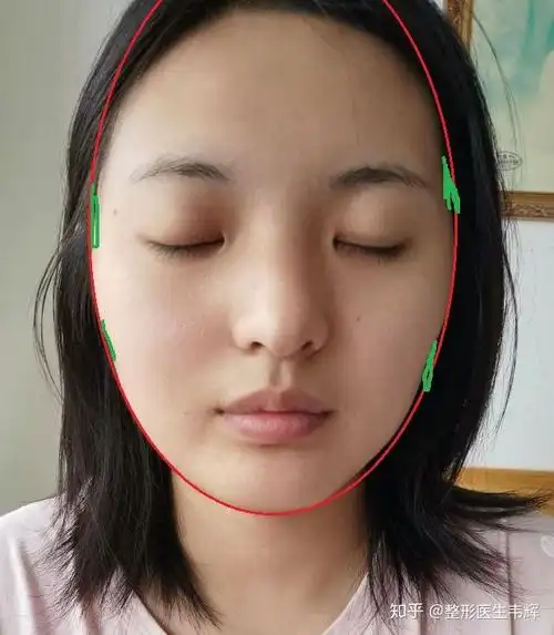 求我这是高颧骨加颧骨突出吗,脸部线条不是很流畅.