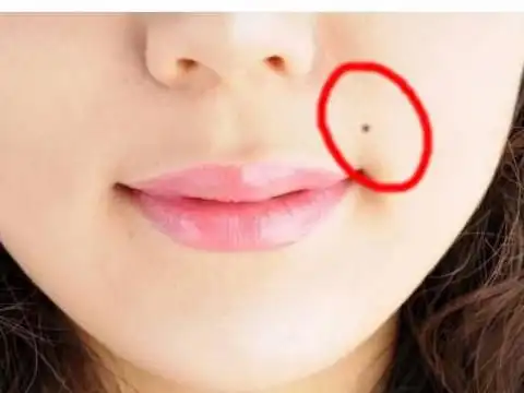 右嘴角痣相图解右边嘴角长痣代表着什么