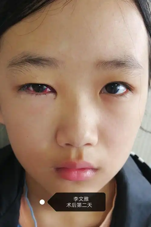 斜视手术病人2020.07.10.13